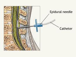 Epidural steroid injection spinal headache